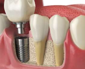 YESDENTISTRY dental implants Adelaide